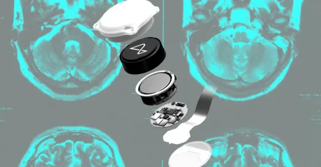 Dispozitivele Neuralink pentru interfețe creier-computer și progresele în comunicare verbală.